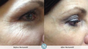 NeriumAD before and after results
